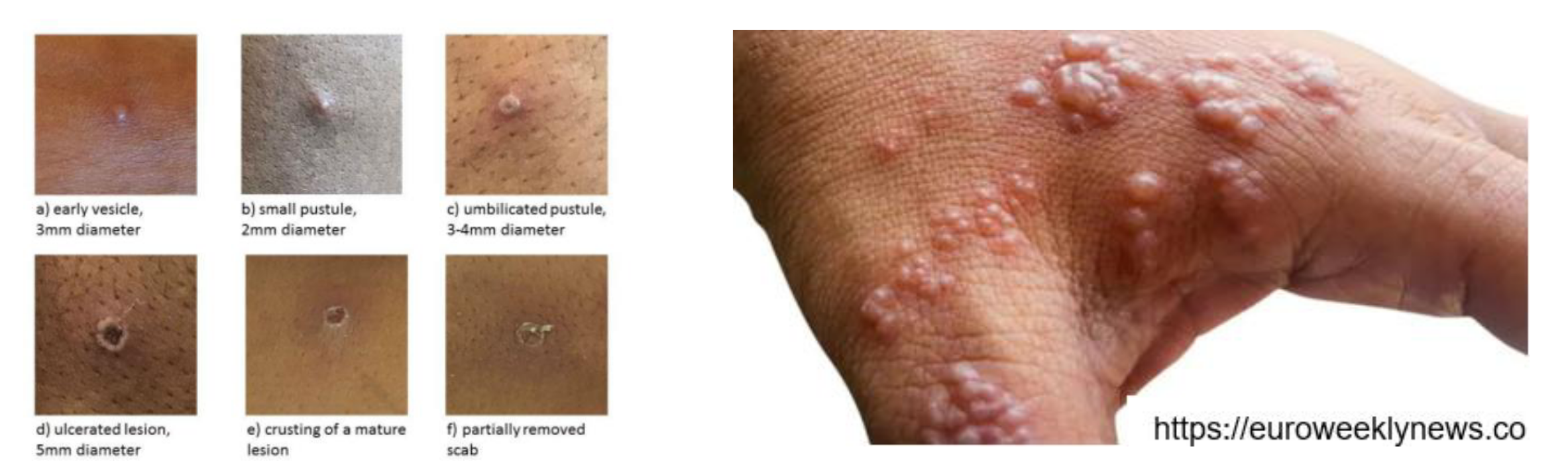 Monkeypox lesion appearance reference